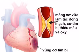 Thay đổi lối sống phòng ngừa nhồi máu cơ tim
