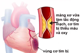 Thay đổi lối sống phòng ngừa nhồi máu cơ tim