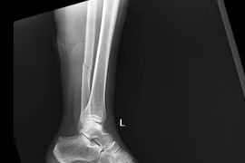 Cảnh báo nguy cơ tai nạn do mưa trơn trượt