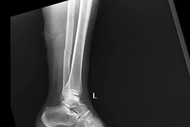 Cảnh báo nguy cơ tai nạn do mưa trơn trượt