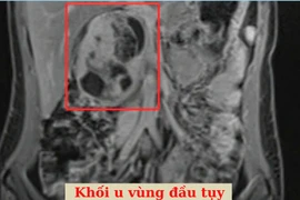 Cô gái 25 tuổi phải cắt cả khối tá tụy sau khi khám sức khỏe định kỳ