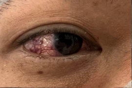 Lồi mắt, đỏ mắt không ngờ bệnh lý hiếm gặp thông động mạch cảnh xoang hang