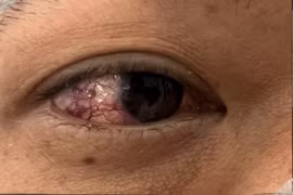 Lồi mắt, đỏ mắt không ngờ bệnh lý hiếm gặp thông động mạch cảnh xoang hang