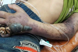 Bị rắn độc cắn, đừng để mất mạng vì tin thầy lang, thuốc lá