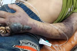 Bị rắn độc cắn, đừng để mất mạng vì tin thầy lang, thuốc lá