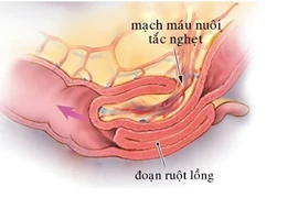 Trẻ 7 tháng tuổi quấy khóc, nôn trớ không ngờ nguy kịch vì lồng ruột