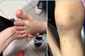 Tự dùng thuốc gút người bệnh dị ứng toàn thân nghiêm trọng