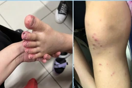 Tự dùng thuốc gút người bệnh dị ứng toàn thân nghiêm trọng