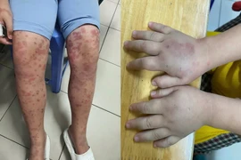 Nhiều trẻ bị ban xuất huyết biến chứng thận nguy hiểm 