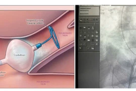 Nhiệt lạnh điều trị rung nhĩ tránh suy tim, đột quỵ