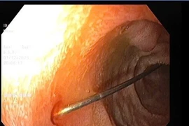 Gắp thành công kim dài 4cm trong tá tràng bé 11 tháng tuổi ngay trong đêm