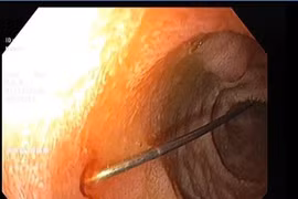 Gắp thành công kim dài 4cm trong tá tràng bé 11 tháng tuổi ngay trong đêm