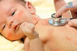Bé sơ sinh 15 ngày tuổi bị thủy đậu biến chứng ác tính