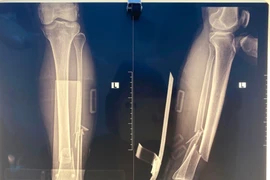 Không thể cử động chân, người đàn ông 71 tuổi gãy kín 2 xương 