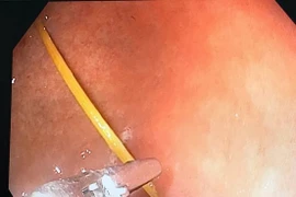 Ngậm tăm ngủ quên gây thủng dạ dày tạo ổ áp xe