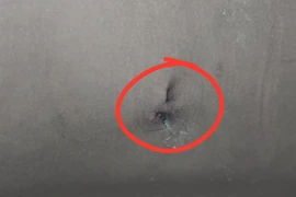 Bé 9 tuổi bị sỏi thận kích thước lớn gây thận ứ nước