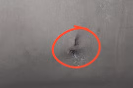 Bé 9 tuổi bị sỏi thận kích thước lớn gây thận ứ nước