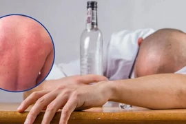 Uống rượu bia bị 'mẩn ngứa, nóng bừng', đừng chủ quan