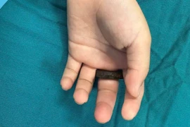 Suýt hoại tử ngón tay vì vòng khóa cửa