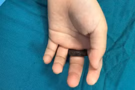 Suýt hoại tử ngón tay vì vòng khóa cửa