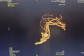 Đau đầu do tăng huyết áp, người phụ nữ 65 tuổi vỡ mạch máu não