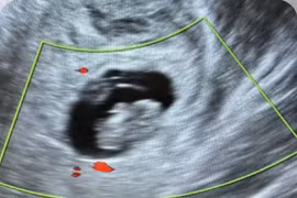 Siêu âm không phát hiện túi thai, thai phụ vỡ khối chửa nguy kịch