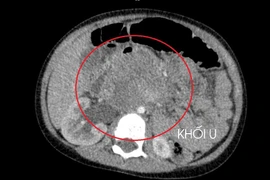 Bé 3 tuổi đã ung thư tinh hoàn, cha mẹ cần chú ý kiểm tra khi trẻ mới sinh