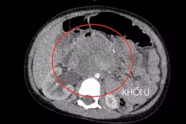 Bé 3 tuổi đã ung thư tinh hoàn, cha mẹ cần chú ý kiểm tra khi trẻ mới sinh