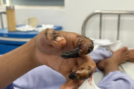 Thanh niên 18 tuổi bị hoại tử các đốt ngón tay do tai nạn lao động