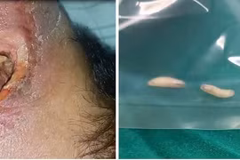 Giòi bò lổn nhổn trong khối loét vùng cổ của cụ ông 82 tuổi