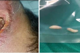 Giòi bò lổn nhổn trong khối loét vùng cổ của cụ ông 82 tuổi