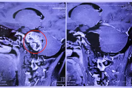 Phẫu thuật thành công u góc cầu tiểu não phức tạp cho 2 bệnh nhân