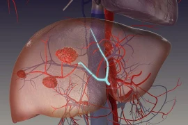 Địa chỉ vàng: Bệnh viện điều trị u máu gan