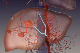 Địa chỉ vàng: Bệnh viện điều trị u máu gan