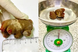 Sỏi san hô “khổng lồ” xâm lấn hết thận sau 20 năm tồn tại 