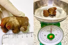 Sỏi san hô “khổng lồ” xâm lấn hết thận sau 20 năm tồn tại 