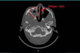 Đau đầu, tắc mũi... kéo dài, Việt kiều Mỹ về Việt Nam chữa viêm xoang nấm