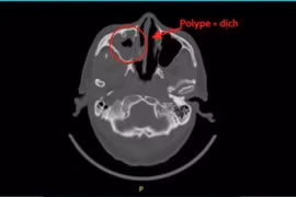 Đau đầu, tắc mũi... kéo dài, Việt kiều Mỹ về Việt Nam chữa viêm xoang nấm