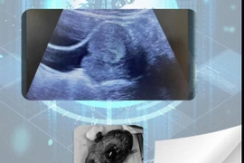 Thiếu nữ 19 tuổi thiếu máu nguy hiểm vì polyp âm đạo lớn