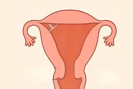 3 lần tháo vòng không thành công vì vòng cắm vào tử cung