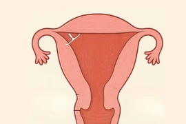 3 lần tháo vòng không thành công vì vòng cắm vào tử cung