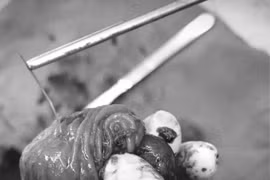 Chàng trai 33 tuổi bị xương cá đâm thủng ruột non, gây áp xe ổ bụng