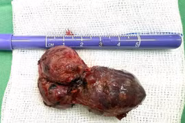 Phẫu thuật u tuyến nước bọt mang tai cho nam bệnh nhân 53 tuổi