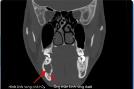 Nhiễm trùng nang xương hàm, phải mổ bỏ 3 răng do chủ quan sâu răng