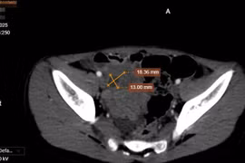 Nang ruột đôi cần phát hiện sớm tránh biến chứng cho trẻ