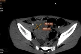 Nang ruột đôi cần phát hiện sớm tránh biến chứng cho trẻ
