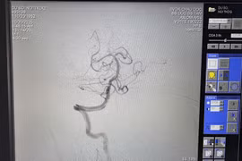 Đang nằm viện trị nhồi máu cơ tim, bệnh nhân đột quỵ do tắc thân nền