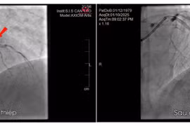 Cứu nam bệnh nhân bị nhồi máu cơ tim cấp sau 2 năm đau ngực âm ỉ