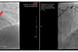 Cứu nam bệnh nhân bị nhồi máu cơ tim cấp sau 2 năm đau ngực âm ỉ