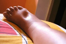 Phù quanh mắt cá chân có phải dấu hiệu của bệnh tim?